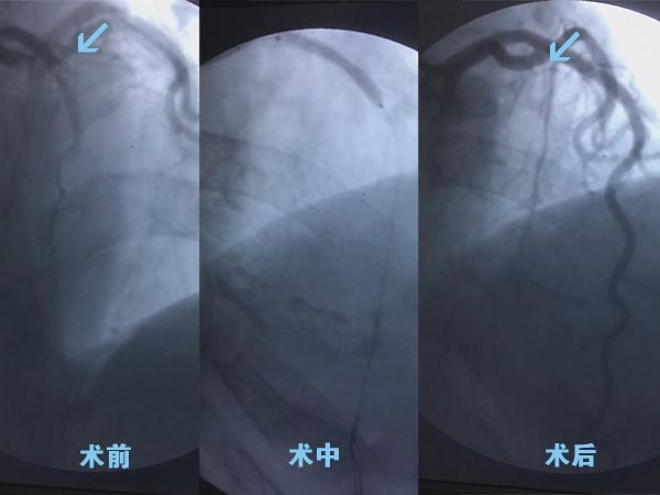 我院成功开展心脏急诊冠脉造影+支架置入术