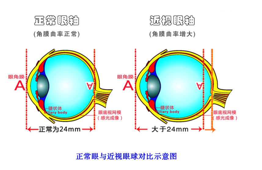 近视眼怎么矫正视力四个方法可行